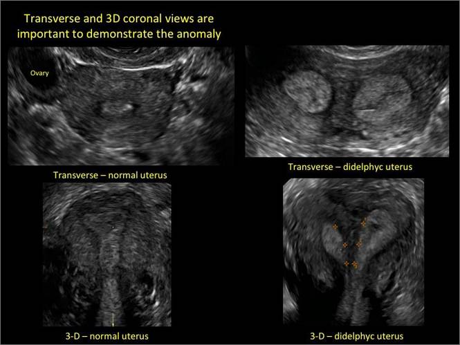 Congenital Uterine Anomalies A Resource Of Diagnostic Images Part