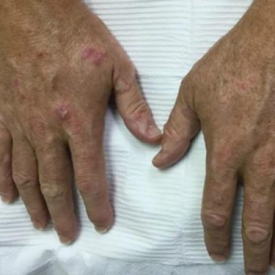 Hypertrophic Lichen Planuslike Eruption Following Pembrolizumab Mdedge Dermatology