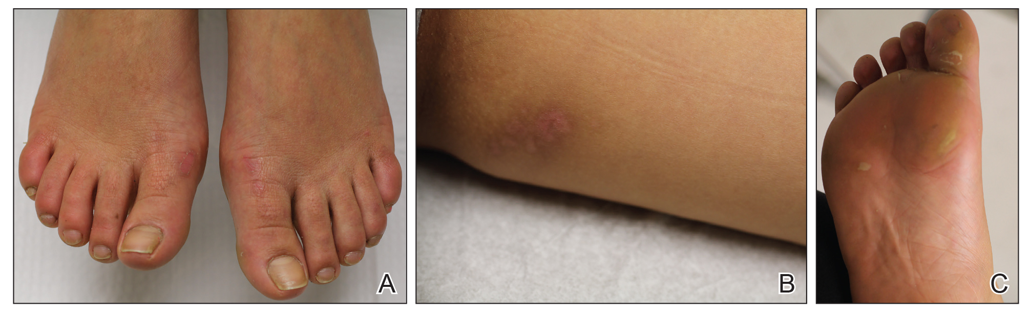 Bothersome Blisters: Localized Epidermolysis Bullosa Simplex | MDedge ...