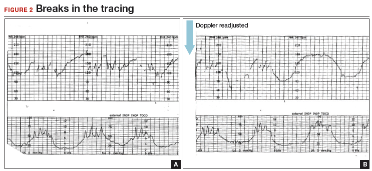 how-to-differentiate-maternal-from-fetal-heart-rate-patterns-on