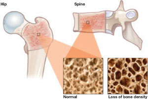 OSTEOPOROSIS | MDedge ObGyn