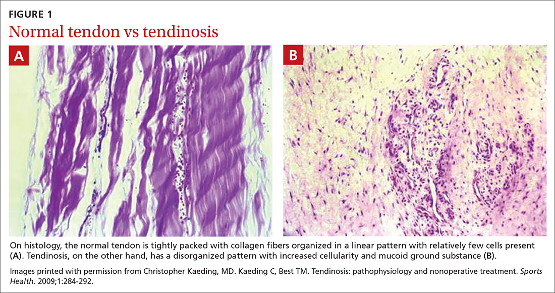 Getting tendinopathy treatment (and terminology) right | MDedge Family ...