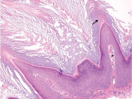 Trichilemmoma | MDedge Dermatology