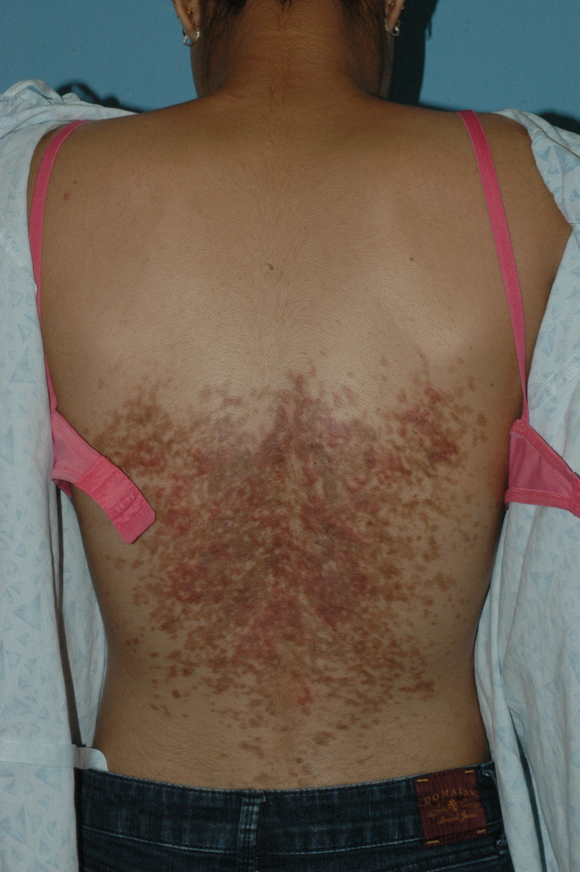 Pediatric Dermatology Consult - February 2017 - Whats your diagnosis?