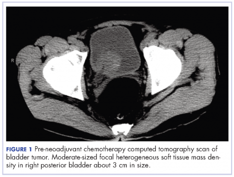Figure , CT scan, bladder tumor