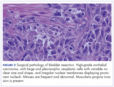 Figure 2, surgical pathology, bladder resection