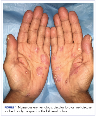 Figure 1 Palmoplantar exacerbation of psoriasis. Erythematous, circular to oval well-circumscribed, scaly plaques on the bilateral palms.