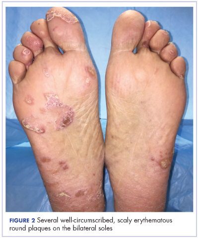 Figure 2 Several well-circumscribed, scaly erythematous round plaques on the bilateral soles