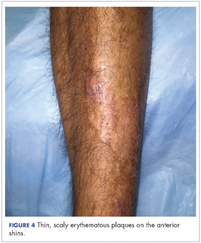 Figure 4 Thin, scaly erythematous plaques on the anterior shins.