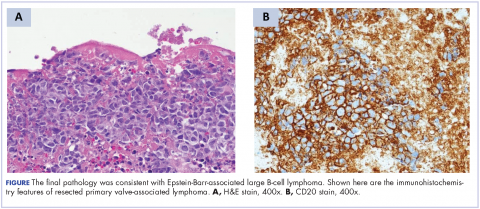 Figure Immunohistochemistry features of resected primary valve-associated lymphoma.