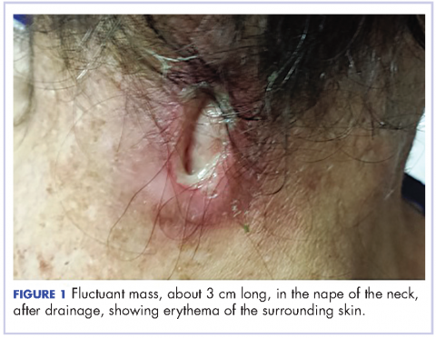 Figure 1 Fluctuant mass, about 3 cm long, in the nape of the neck, after drainage, showing erythema of the surrounding skin.