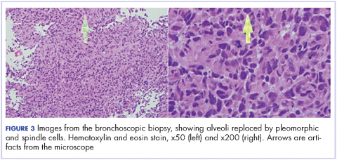 Figure 3 Images from the bronchoscopic biopsy, showing alveoli replaced by pleomorphic and spindle cells.