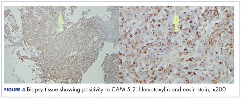 Figure 4 Biopsy tissue showing positivity to CAM 5.2