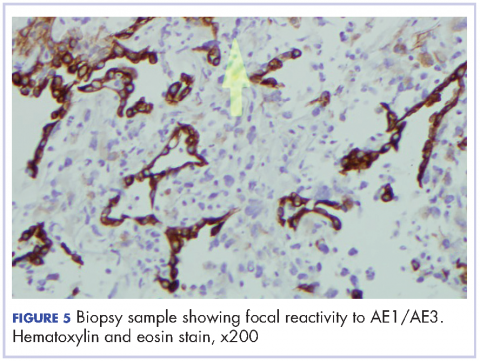 Figure 5 Biopsy sample showing focal reactivity to AE1/AE3.