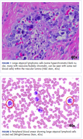 Figure 1 large atypical lymphoma cells, and Figure 2 peripheral lood smear showing large atypical lymphoid cells