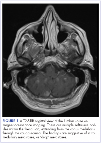 Figure 1 Intramedullary spinal cord and leptomeningeal metastases melanoma T2-STIR sagittal view of the lumbar spine on MRI