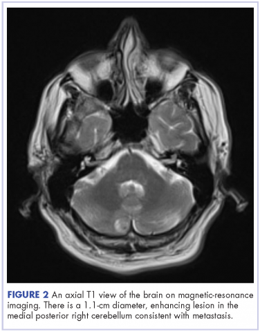 Figure 2 Intramedullary spinal cord and leptomeningeal metastases melanoma - axial T1 view of the brain on MRI