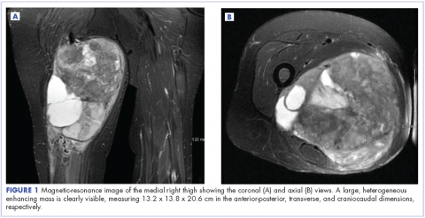 Figure 1 Pleomorphic sarcoma with colon metastasis - MRI of the medial right thigh showing the coronal and axial views.