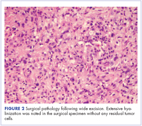 Figure 2 Pleomorphic sarcoma with colon metastasis - surgical pathology following wide excision