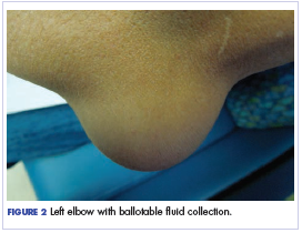 Figure 2 Left elbow with ballotable <?AID 001f?>uid collection.