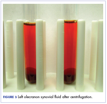 Figure 3 Left olecranon synovial <?AID 001f?>uid after centrifugation.