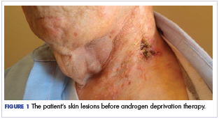 Figure 1 The patient’s skin lesions before androgen deprivation therapy.