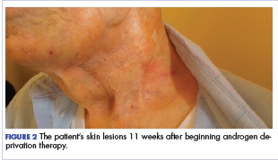 Figure 2 The patient’s skin lesions 11 weeks after beginning androgen deprivation therapy.