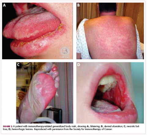 Figure 2 Immunotherapy-related body rash, showing blistering; dermal ulceration; necrotic bullous; and hemorrhagic lesions.