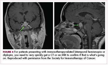 Figure 4 Patient with immunotherapy-related bitemporal hemianopia or diplopia needs scans as soon as possible.