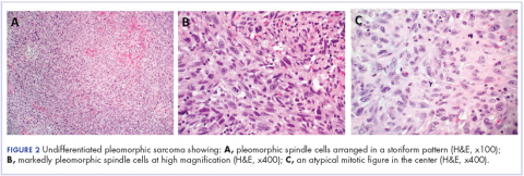 Figure 2. Undifferentaited pleomorphic sarcoma from histologic/IHC findings.