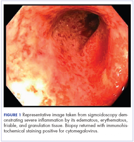 Figure 1. Image from sigmoidoscopy showing severe infl<?AID 001f?>ammation by its edematous, erythematous, friable, and granulation tissue.