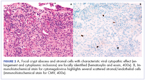 Figure 3. Image A, Focal crypt abscess and stromal cells with characteristic viral cytopathic effect. Image B, Immunohistochemical stain for cytomegalovirus.