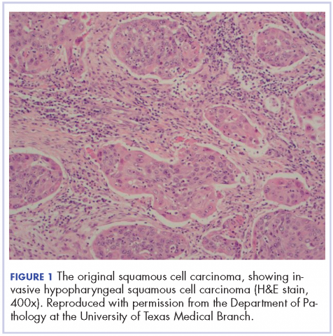 Figure 1. The original SCC, showing invasive hypopharyngeal squamous cell carcinoma (H&E stain, 400x).