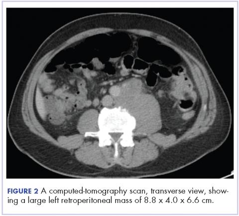 Figure 2. A CT scan, transverse view, showing a large left retroperitoneal mass of 8.8 x 4.0 x 6.6 cm.