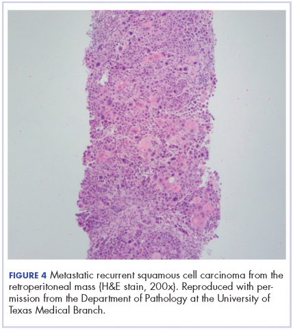 Figure 4. Metastatic recurrent SCC from the retroperitoneal mass (H&E stain, 200x).