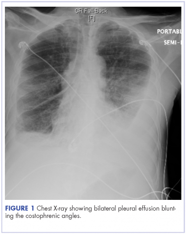 Figure 1 Chest X-ray showing bilateral pleural effusion blunting the costophremic angles.