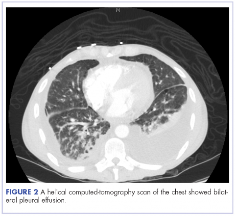 Figure 2 A helical CT scan of the chest showing bilateral pleural effusion