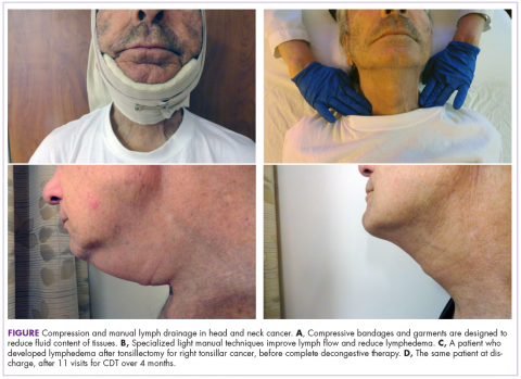 Figure Compression and manual lymph drainage in head and neck cancer