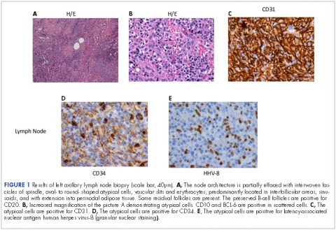 Figure 1 Results of left axillary lymph node biopsy