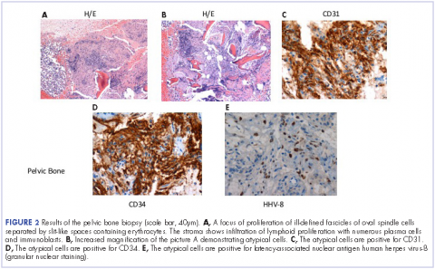 Figure 2 Results of the pelvic bone biopsy