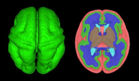 Quantitative volumetric MRI analysis of the fetal brain: Axial view of 3D fetal cortex and computer based segmentation