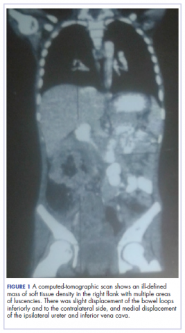 Figure 1. child with carcinoma of the colon. CT scan
