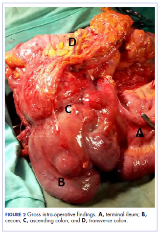 Figure 2. Child with colon carcinoma, intra-operative findings