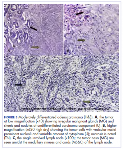 Figure 3. Child with colon carcioma, Moderately differentiated adenocarcinoma
