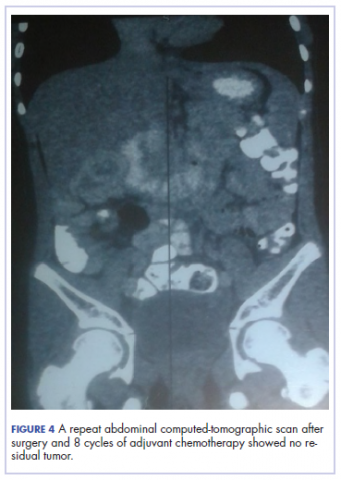 Figure 4. Child with colon carcinoma, postsurgery CT scan.