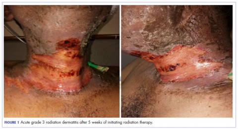Figure 1. Postradiation dermatitis
