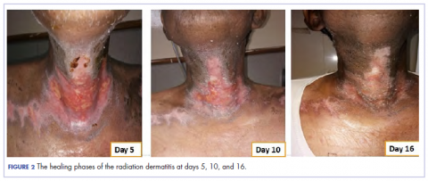 Figure 2. healing phases of postradiation dermatitis, days 5, 10, 16