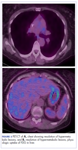 Figure 2. PET scan showing resolution of hypermetabolic lesions.