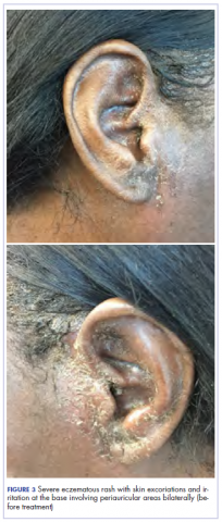 Figure 3. Severe eczematous rash with skin excoriations and irritation at the base involving periauricular areas bilaterally (before treatment)