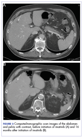 CT scan before and after treatment with imatinib